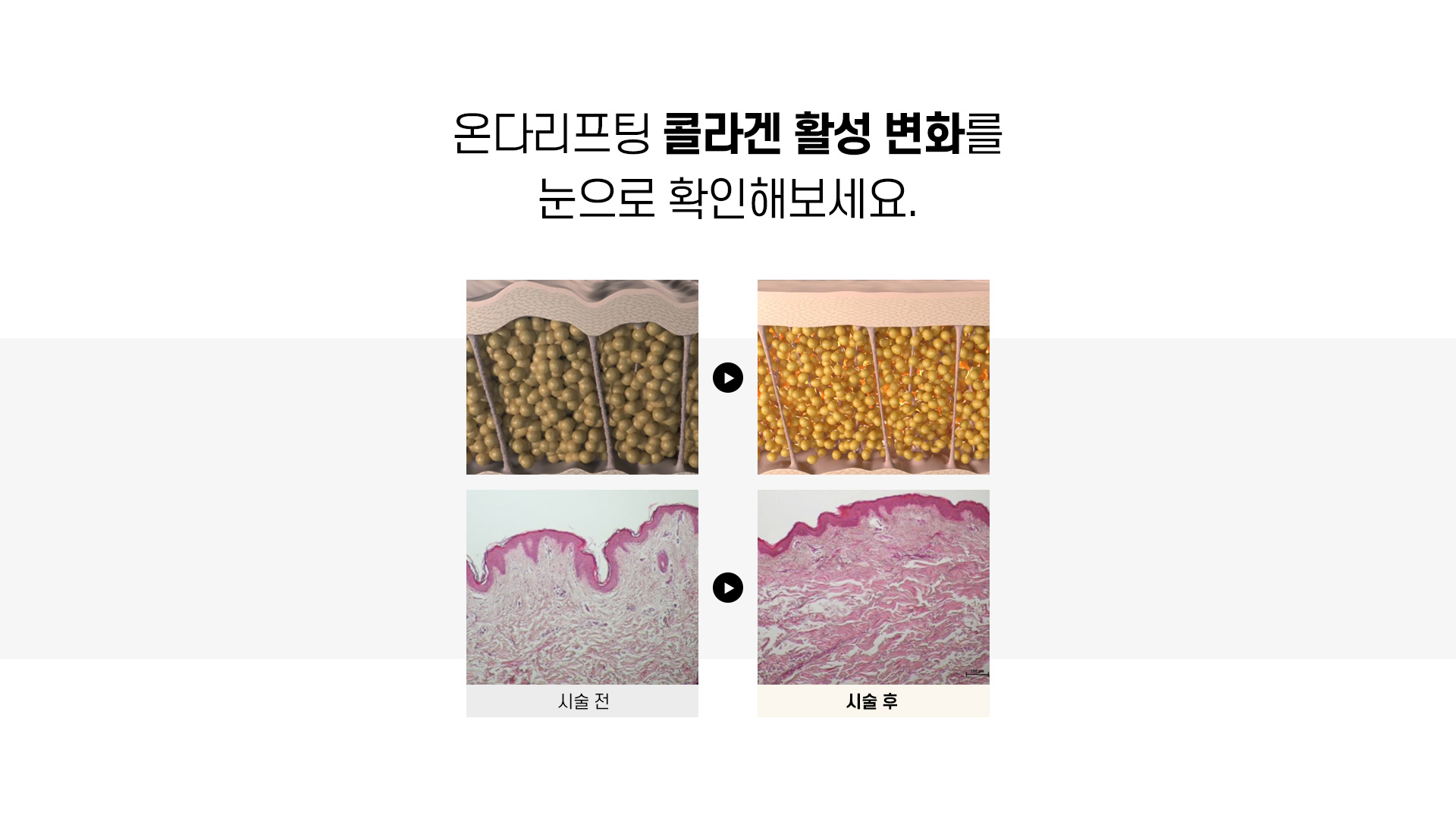 온다리프팅_04