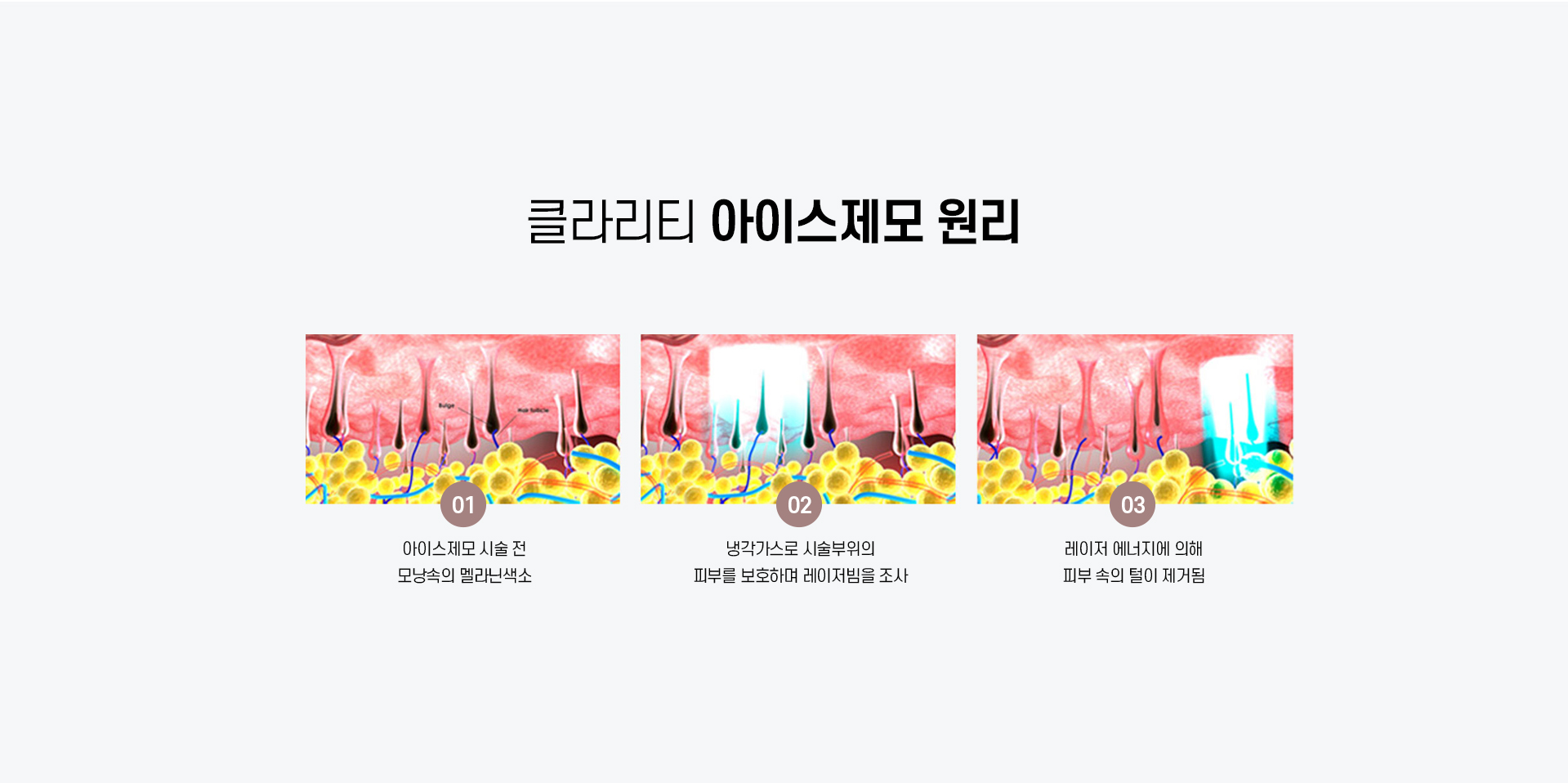 레이저 제모_05