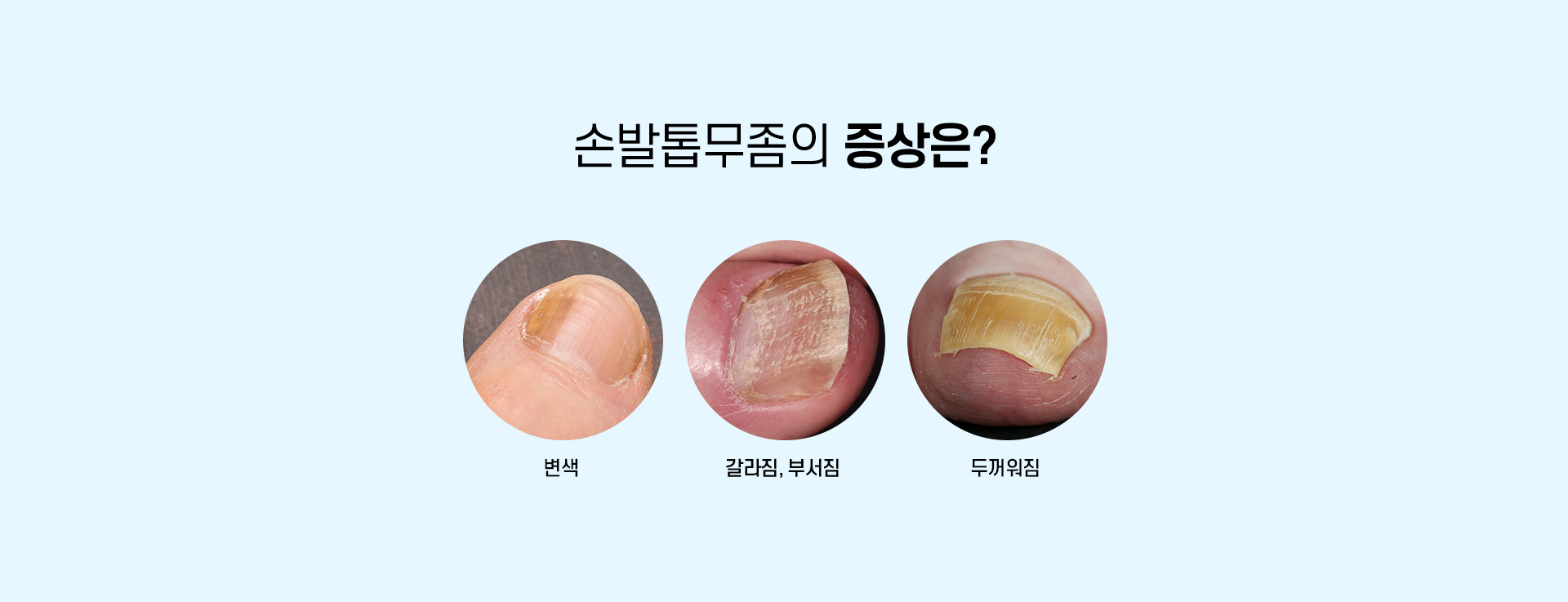 무좀치료_05
