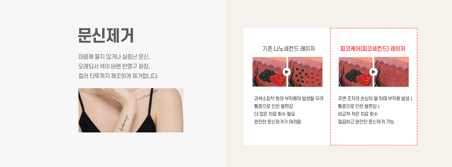 문신제거