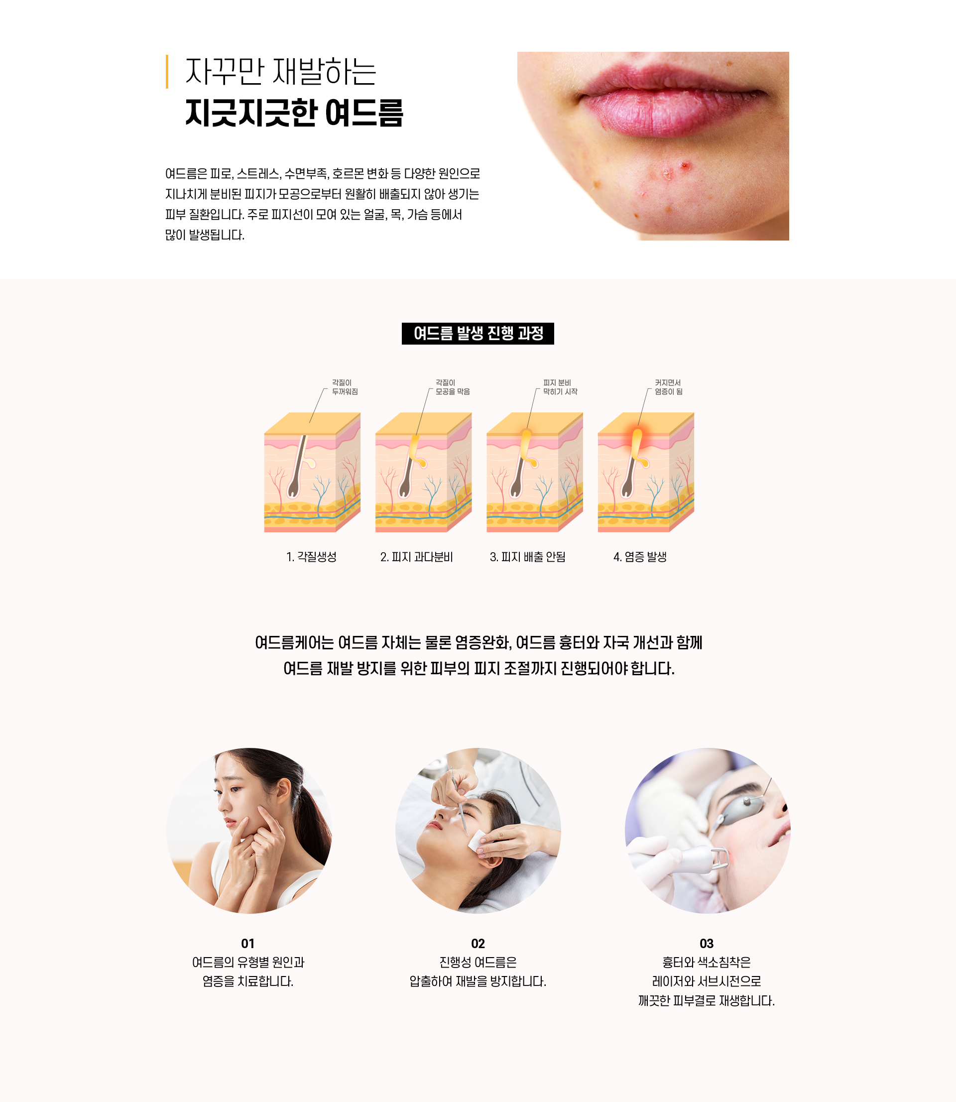 여드름